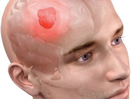 Brain Tumor